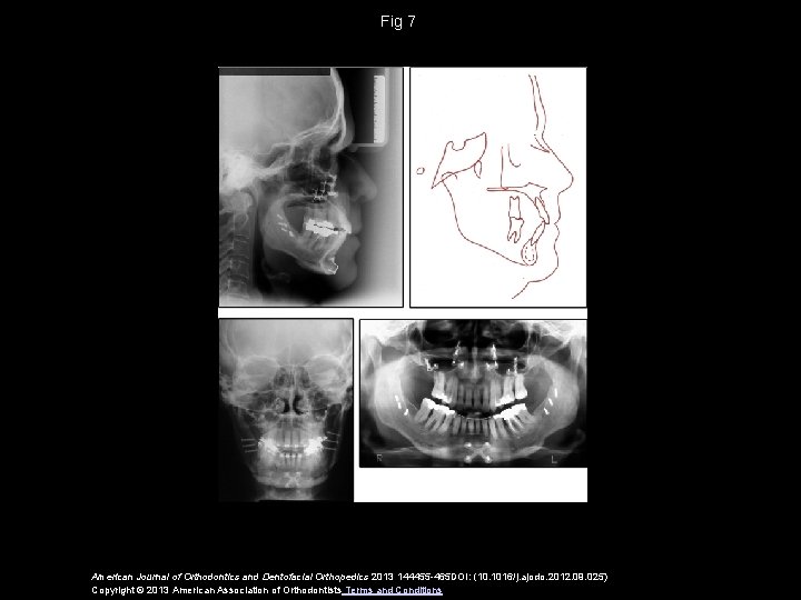 Fig 7 American Journal of Orthodontics and Dentofacial Orthopedics 2013 144455 -465 DOI: (10.