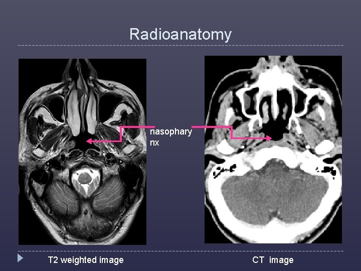 Radioanatomy nasophary nx T 2 weighted image CT image 