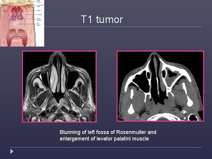  T 1 tumor Blunning of left fossa of Rosenmuller and enlargement of levator
