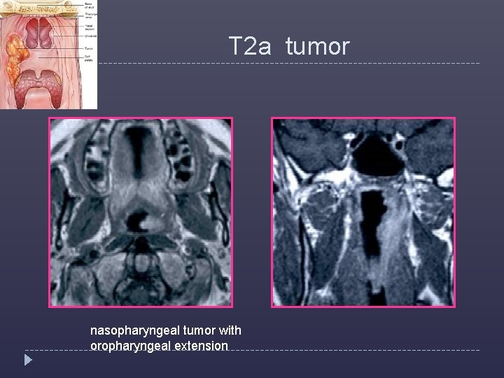  T 2 a tumor nasopharyngeal tumor with oropharyngeal extension 