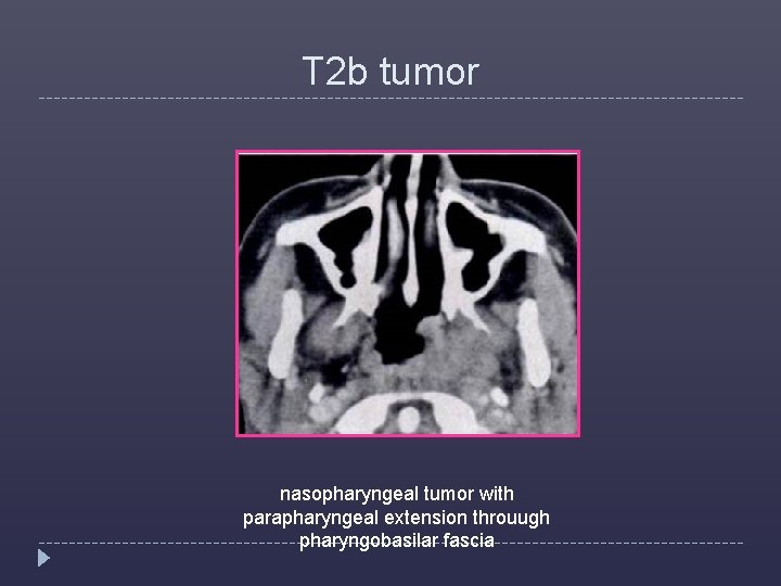 T 2 b tumor nasopharyngeal tumor with parapharyngeal extension throuugh pharyngobasilar fascia 