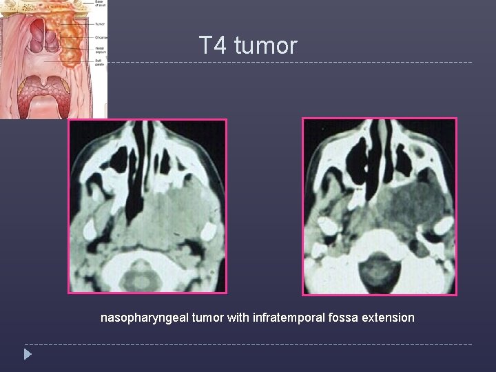 T 4 tumor nasopharyngeal tumor with infratemporal fossa extension 