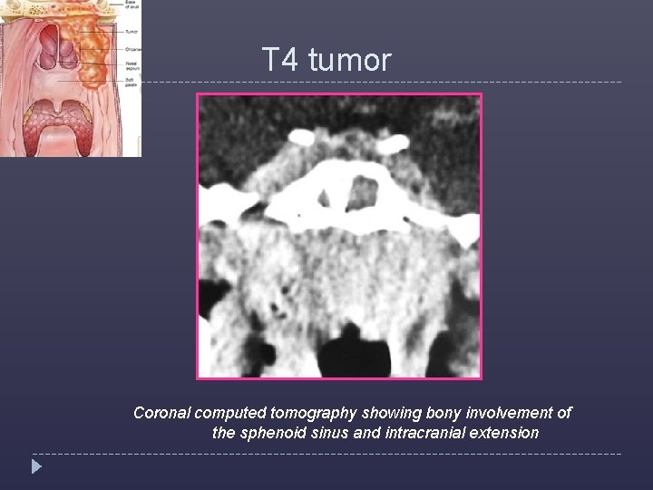 T 4 tumor Coronal computed tomography showing bony involvement of the sphenoid sinus and