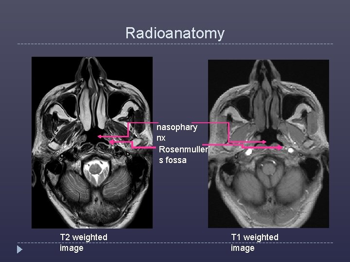 Radioanatomy nasophary nx Rosenmuller’ s fossa T 2 weighted image T 1 weighted image