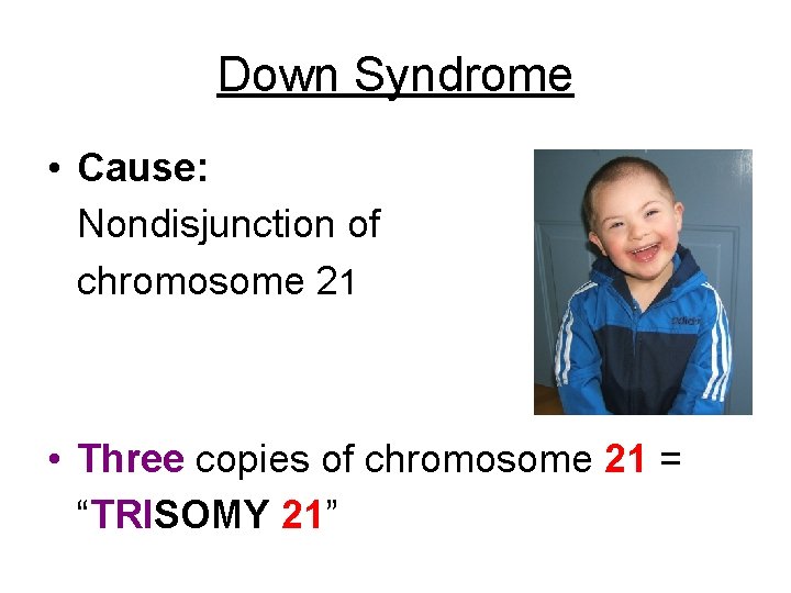 Down Syndrome • Cause: Nondisjunction of chromosome 21 • Three copies of chromosome 21