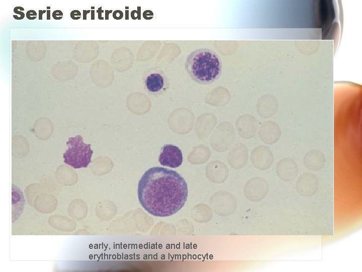 Serie eritroide early, intermediate and late erythroblasts and a lymphocyte Serie eritroide early, intermediate and late erythroblasts and a lymphocyte