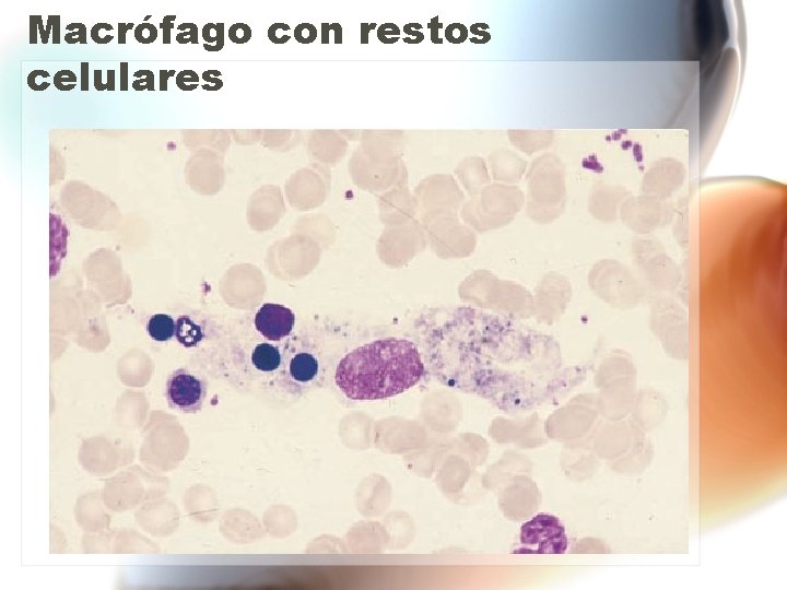 Macrófago con restos celulares Macrófago con restos celulares