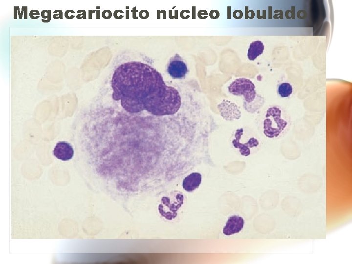 Megacariocito núcleo lobulado Megacariocito núcleo lobulado