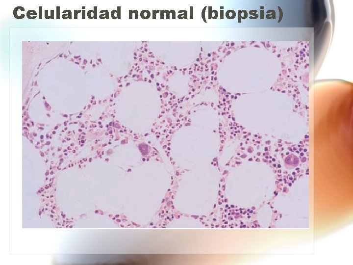 Celularidad normal (biopsia) Celularidad normal (biopsia)