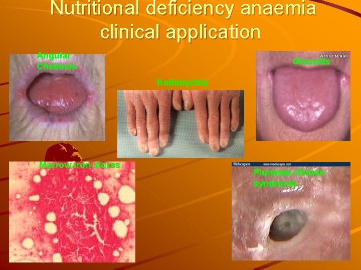 Nutritional deficiency anaemia clinical application Angular Cheilosis Glossitis Koilonychia Marrow iron stores Plummer-Vinson syndrome