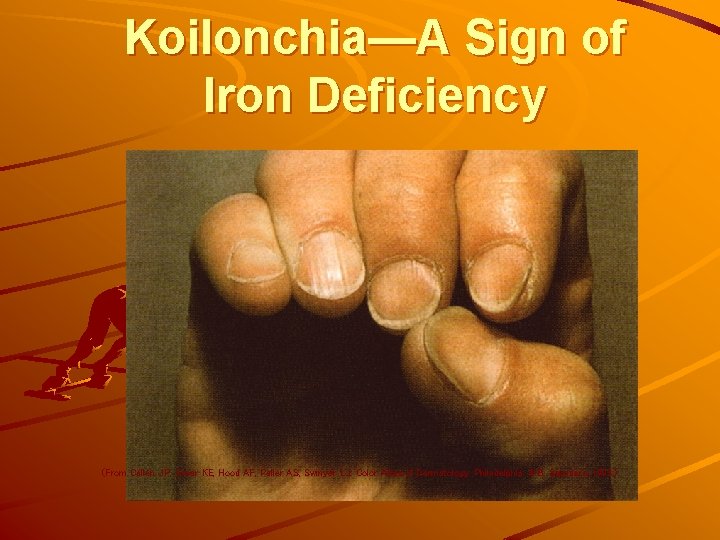 Koilonchia—A Sign of Iron Deficiency (From Callen JP, Greer KE, Hood AF, Paller AS,