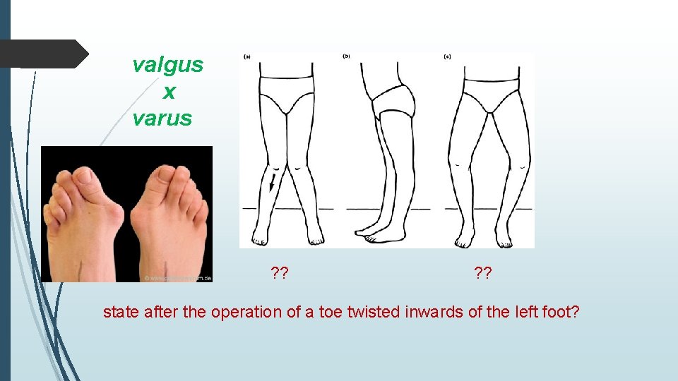 valgus x varus ? ? state after the operation of a toe twisted inwards