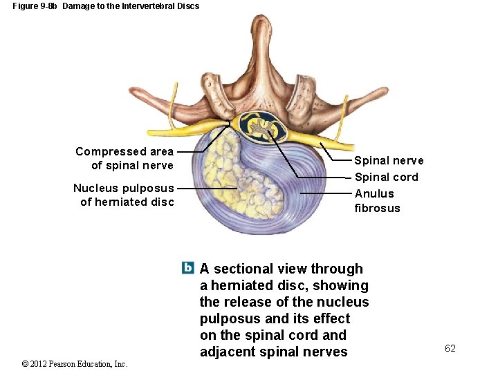 Figure 9 -8 b Damage to the Intervertebral Discs Compressed area of spinal nerve