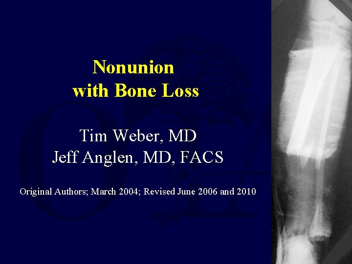 Nonunion with Bone Loss Tim Weber, MD Jeff Anglen, MD, FACS Original Authors; March