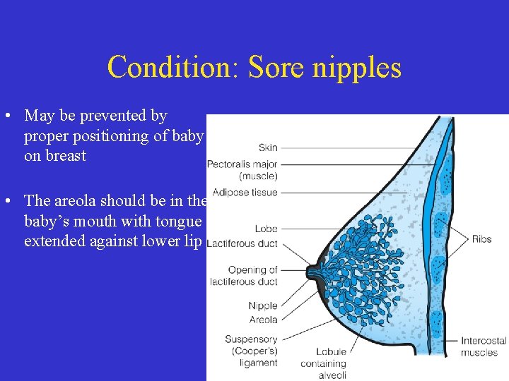 Condition: Sore nipples • May be prevented by proper positioning of baby on breast