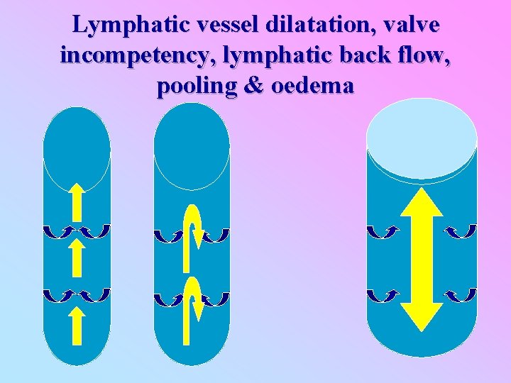 Lymphatic vessel dilatation, valve incompetency, lymphatic back flow, pooling & oedema 