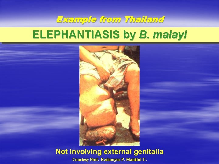 Example from Thailand ELEPHANTIASIS by B. malayi Not involving external genitalia Courtesy Prof. Radomyos