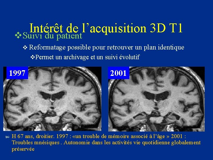 Intérêt de l’acquisition 3 D T 1 v. Suivi du patient v Reformatage possible