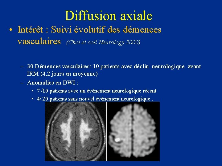 Diffusion axiale • Intérêt : Suivi évolutif des démences vasculaires (Choi et coll Neurology