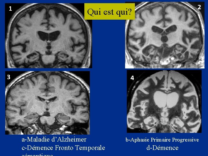 1 Qui est qui? 3 4 2 2 a-Maladie d’Alzheimer c-Démence Fronto Temporale b-Aphasie