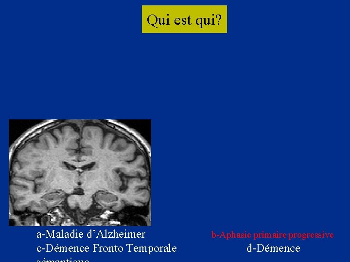 Qui est qui? 2 3 a-Maladie d’Alzheimer c-Démence Fronto Temporale b-Aphasie primaire progressive d-Démence