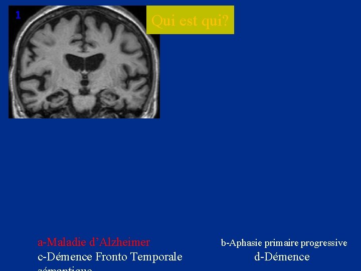 1 Qui est qui? 2 a-Maladie d’Alzheimer c-Démence Fronto Temporale b-Aphasie primaire progressive d-Démence