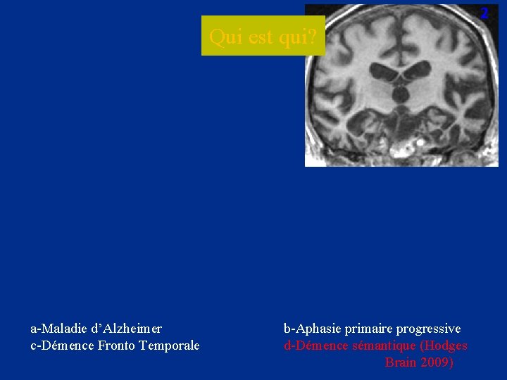 2 Qui est qui? a-Maladie d’Alzheimer c-Démence Fronto Temporale b-Aphasie primaire progressive d-Démence sémantique