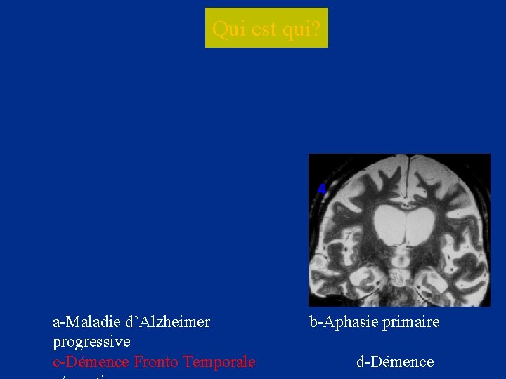 Qui est qui? 2 4 a-Maladie d’Alzheimer progressive c-Démence Fronto Temporale b-Aphasie primaire d-Démence