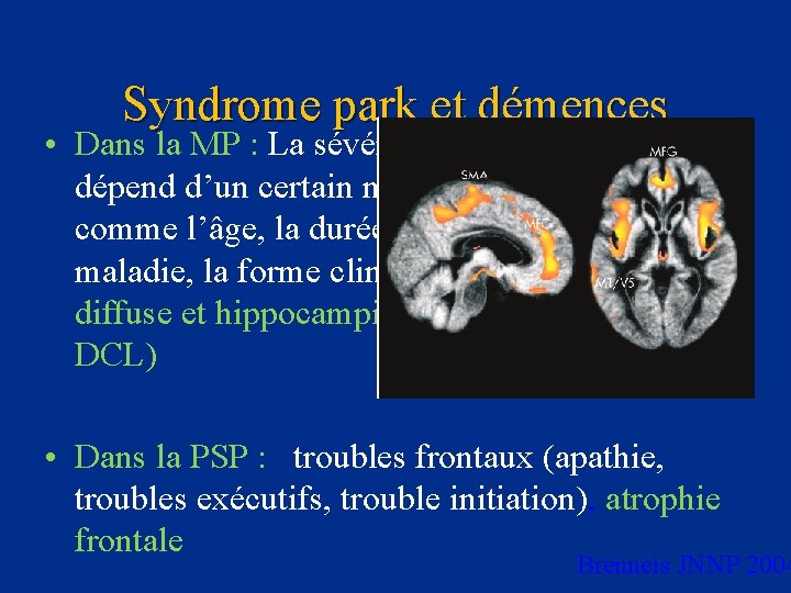 Syndrome park et démences • Dans la MP : La sévérité des troubles cognitifs