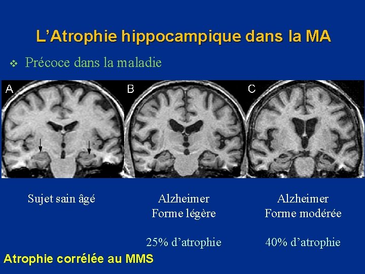 L’Atrophie hippocampique dans la MA v Précoce dans la maladie Sujet sain âgé Alzheimer