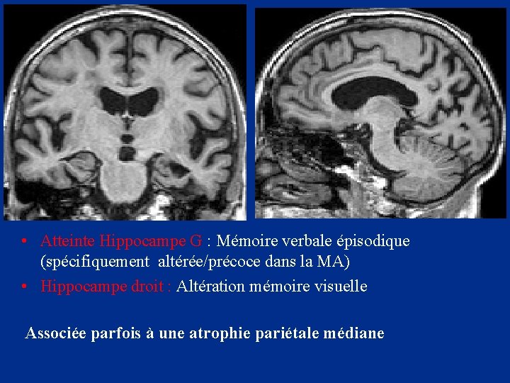  • Atteinte Hippocampe G : Mémoire verbale épisodique (spécifiquement altérée/précoce dans la MA)