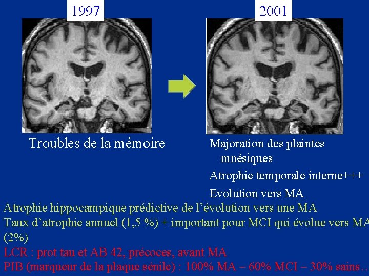 1997 2001 Troubles de la mémoire Majoration des plaintes mnésiques Atrophie temporale interne+++ Evolution