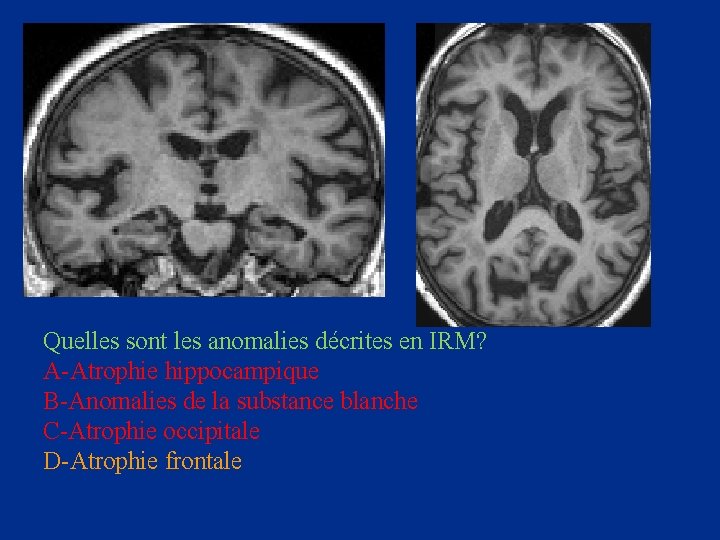 Quelles sont les anomalies décrites en IRM? A-Atrophie hippocampique B-Anomalies de la substance blanche