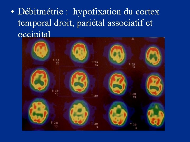  • Débitmétrie : hypofixation du cortex temporal droit, pariétal associatif et occipital 