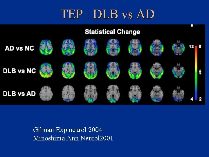 TEP : DLB vs AD Gilman Exp neurol 2004 Minoshima Ann Neurol 2001 