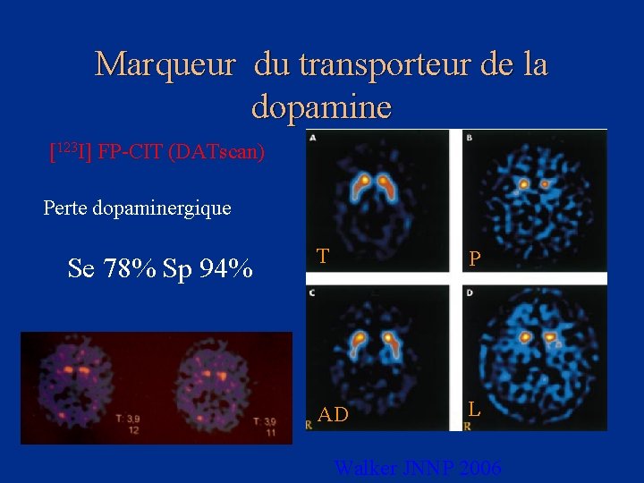 Marqueur du transporteur de la dopamine [123 I] FP-CIT (DATscan) Perte dopaminergique Se 78%