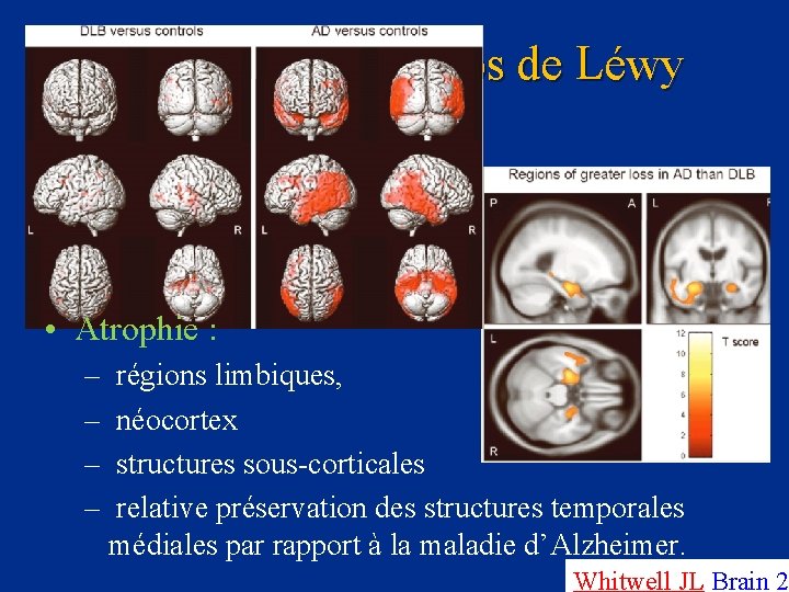 La démence à Corps de Léwy • Atrophie : – régions limbiques, – néocortex
