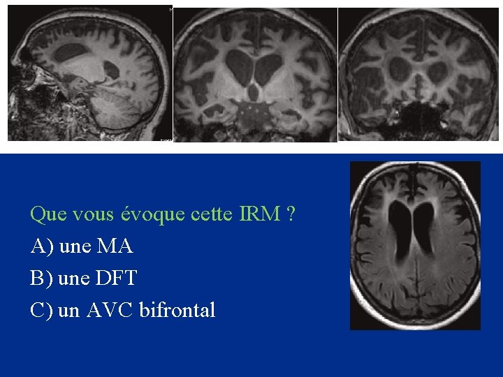Que vous évoque cette IRM ? A) une MA B) une DFT C) un