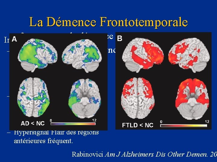 La Démence Frontotemporale • 3 eme cause de démence neurodégénérative Imagerie : Regroupe différents