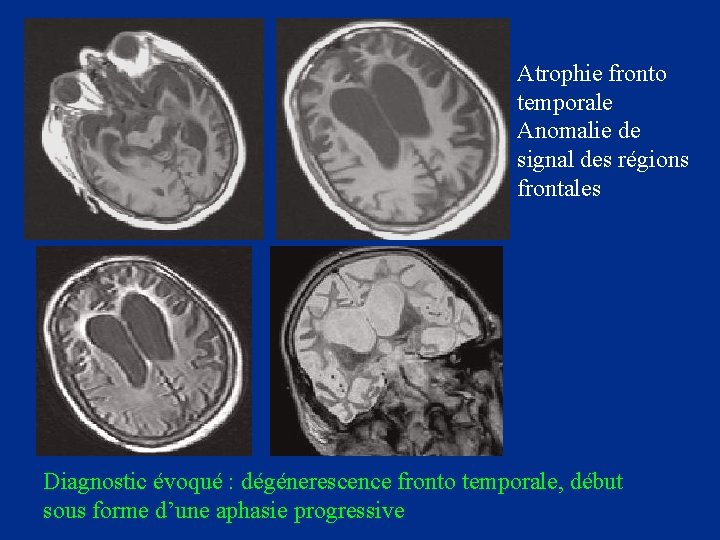 Atrophie fronto temporale Anomalie de signal des régions frontales Diagnostic évoqué : dégénerescence fronto