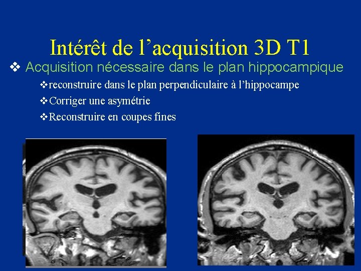 Intérêt de l’acquisition 3 D T 1 v Acquisition nécessaire dans le plan hippocampique