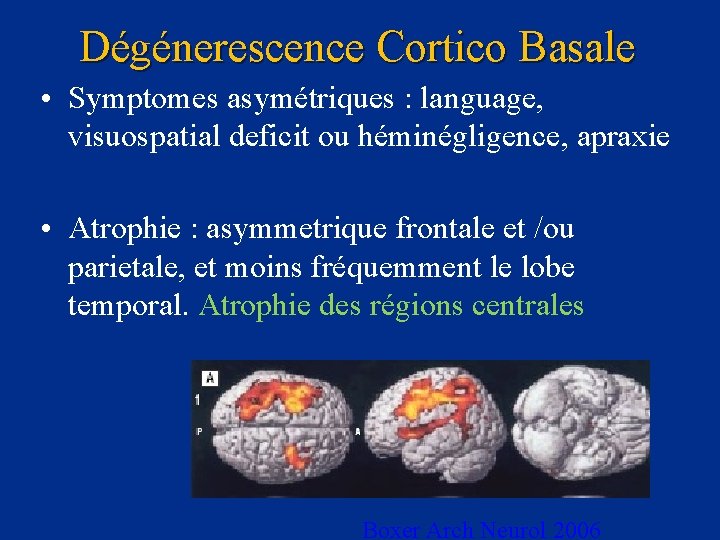 Dégénerescence Cortico Basale • Symptomes asymétriques : language, visuospatial deficit ou héminégligence, apraxie •