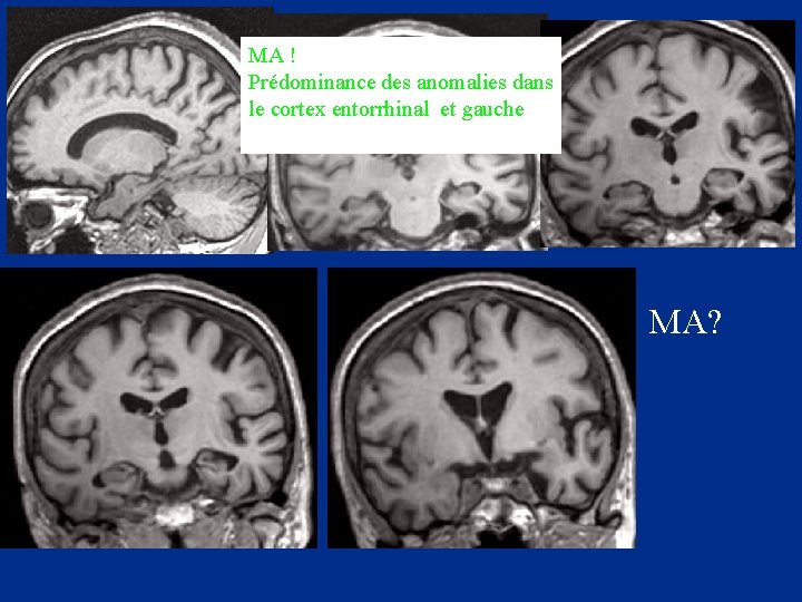 MA ! Prédominance des anomalies dans le cortex entorrhinal et gauche MA? 