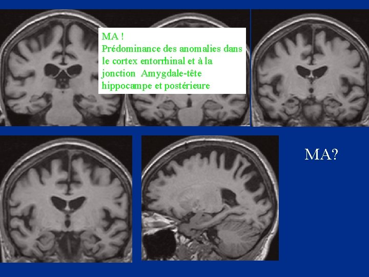 MA ! Prédominance des anomalies dans le cortex entorrhinal et à la jonction Amygdale-tête