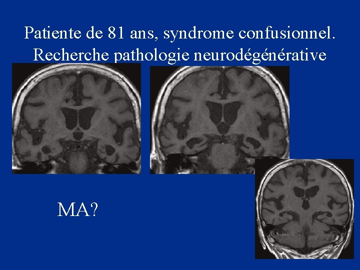 Patiente de 81 ans, syndrome confusionnel. Recherche pathologie neurodégénérative MA? 