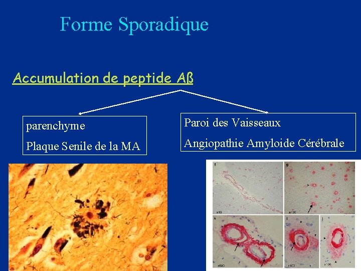 Forme Sporadique Accumulation de peptide Aß parenchyme Paroi des Vaisseaux Plaque Senile de la