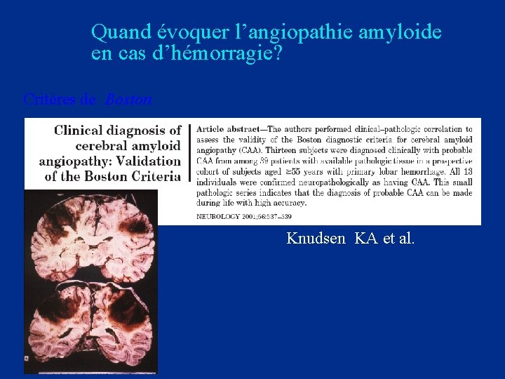 Quand évoquer l’angiopathie amyloide en cas d’hémorragie? Critères de Boston Knudsen KA et al.