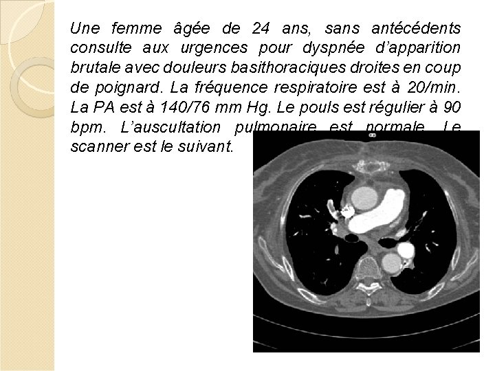 Une femme âgée de 24 ans, sans antécédents consulte aux urgences pour dyspnée d’apparition