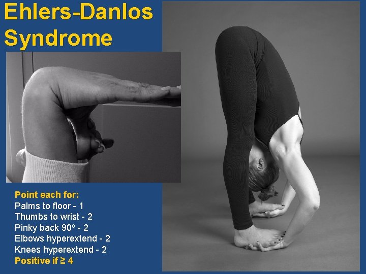 Ehlers-Danlos Syndrome Point each for: Palms to floor - 1 Thumbs to wrist -