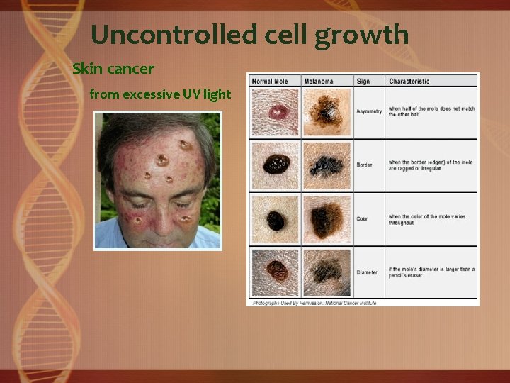 Uncontrolled cell growth Skin cancer from excessive UV light 